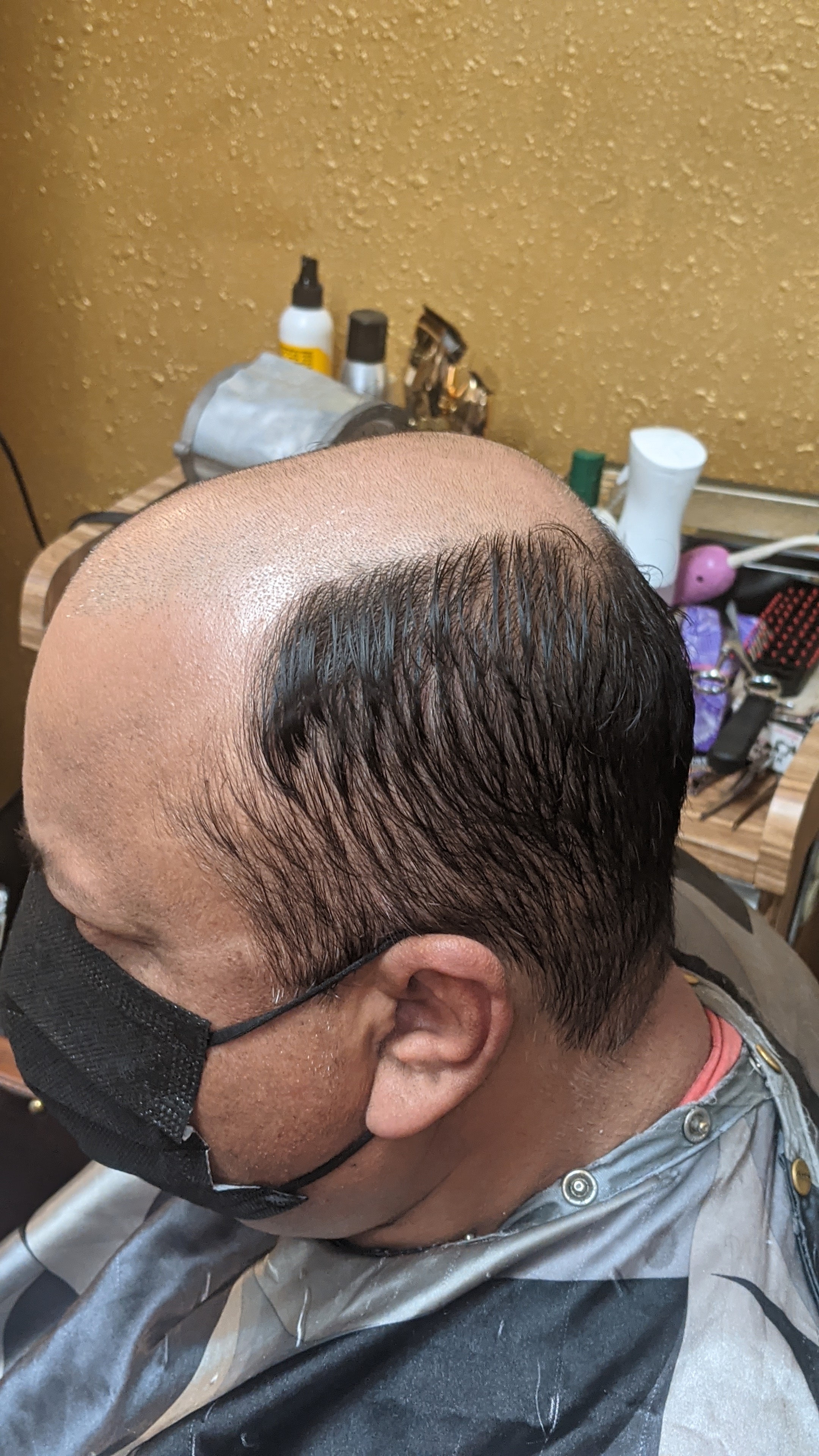 Hair Transplant Lees Summit Missouri